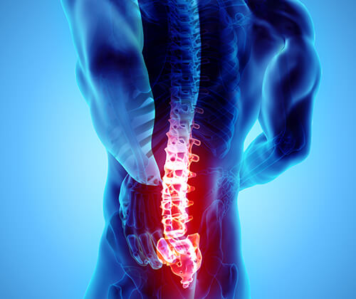 Back Pain Treatment in Naples, Fort Myers & Cape Coral, FL
