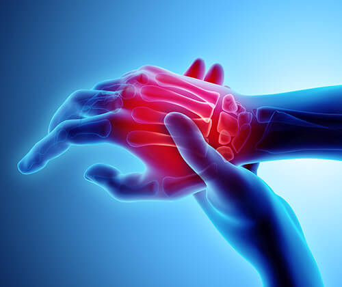 Hand Wrist Pain Treatment in Naples, Fort Myers & Cape Coral, FL