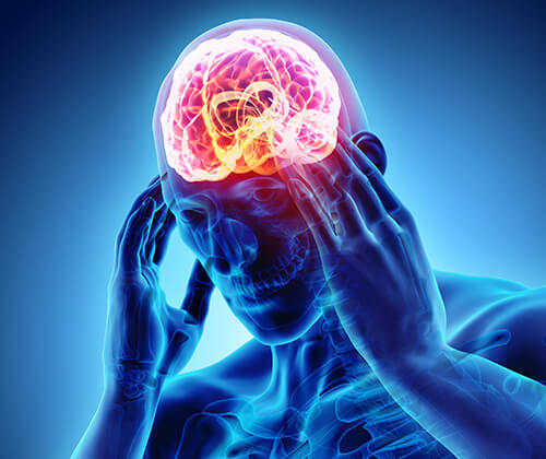 Headache Treatment in Naples, Fort Myers & Cape Coral, FL