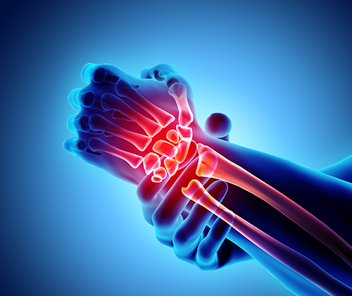 Joint Pain Treatment in Naples, Fort Myers & Cape Coral, FL